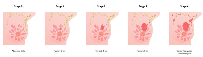 Stages of breast cancer