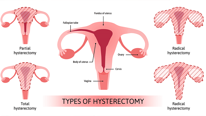 Types of hysterectomy