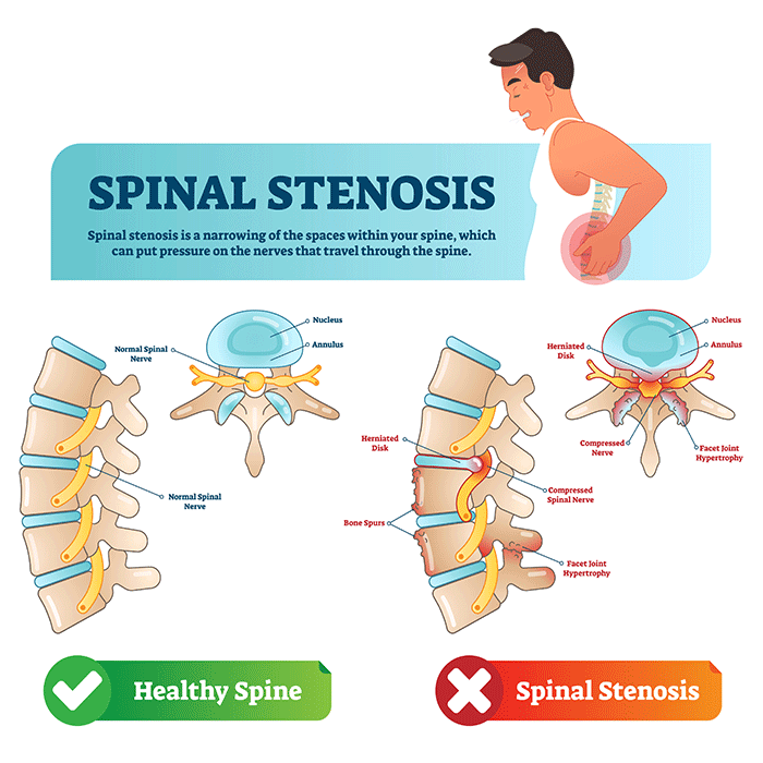 Spinal Stenosis Symptoms Causes Och Spine At NewYork Presbyterian Spinal Stenosis Symptoms Causes Och Spine At NewYork Presbyterian