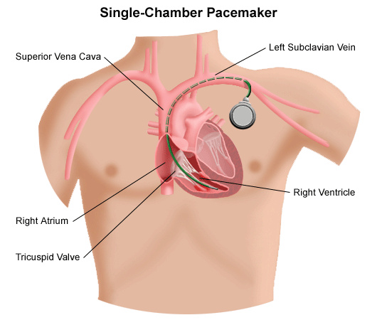 pacemaker