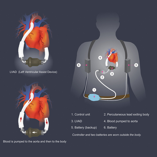 left ventricular assist device (LVAD)